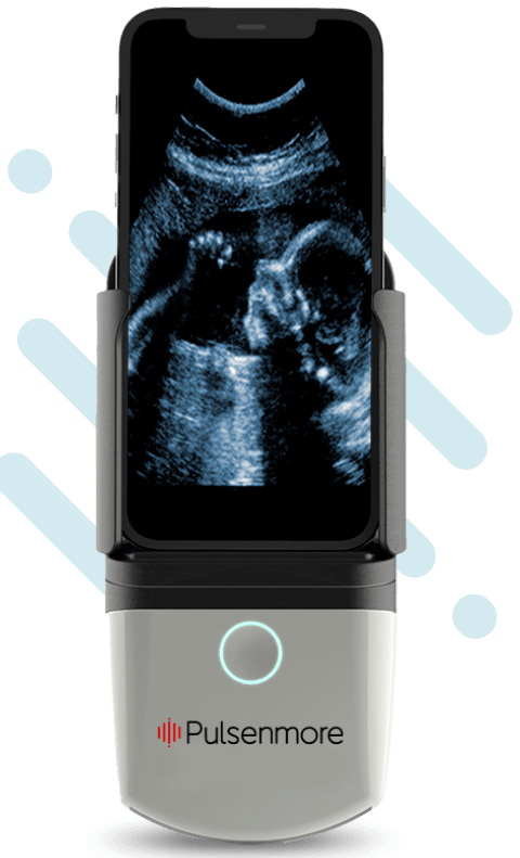 Pulsenmore home ultrasound cradle attached with smartphone