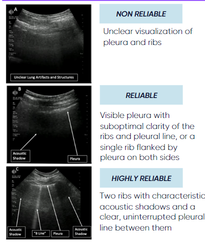 Detection of lung B-lines and evaluating scan quality