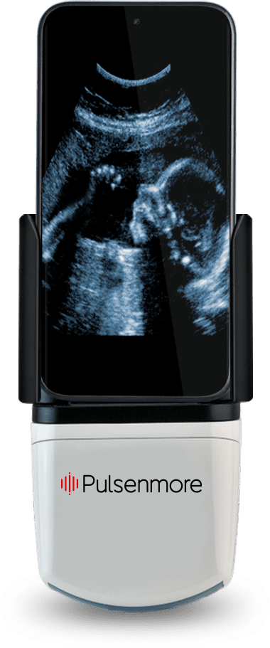 Pulsenmore home ultrasound cradle attached with smartphone